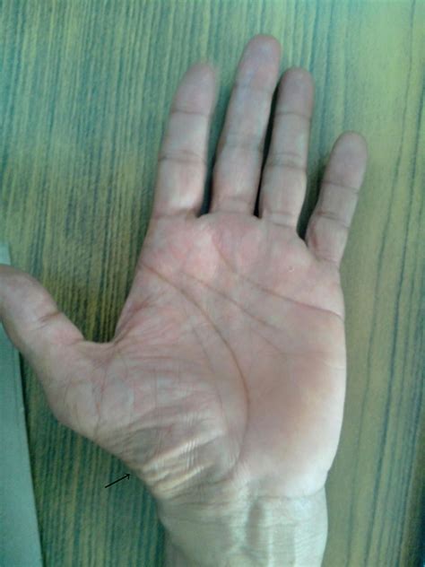 Amyotrophic lateral sclerosis presenting as typical split hand syndrome ...