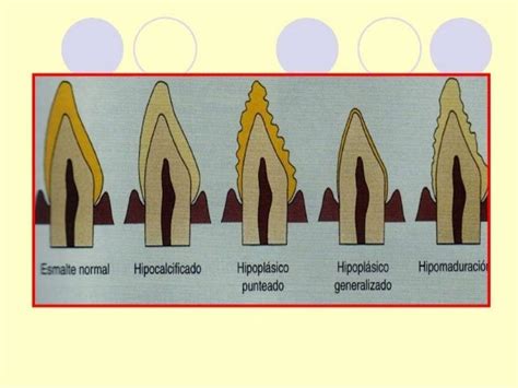 Amelogenesis Imperfecta Types