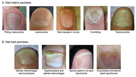 Nail psoriasis severity index | doctorvisit