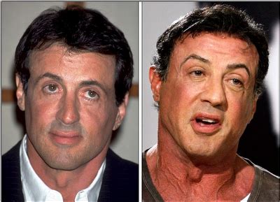 Sylvester Stallone Plastic Surgery