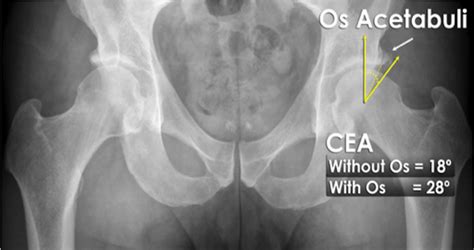 Arthroscopic Fixation of Os Acetabuli Technique: When to Resect and ...