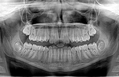 The Science of Modern Dental X-Rays | Grafton Dental Care