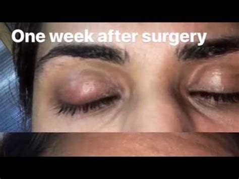 chalazion surgery recovery time - Captions Definition