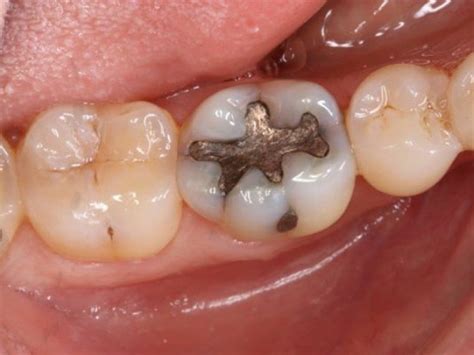 Abscessed Tooth (Dental Abscess): Symptoms, Types, Treatment & Prevention - Boldsky.com