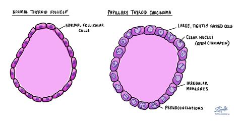 Papillary thyroid carcinoma - MyPathologyReport.ca