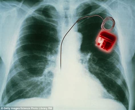 Imagine horror of hearing your heart implant is faulty | Daily Mail Online