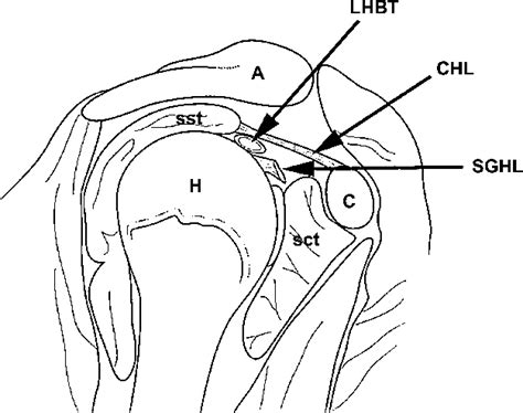 Figure 1 from MRI of the rotator interval of the shoulder. | Semantic Scholar