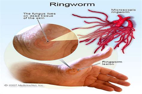 14 Effective Home Remedies That will Help you Get Rid of Ringworm