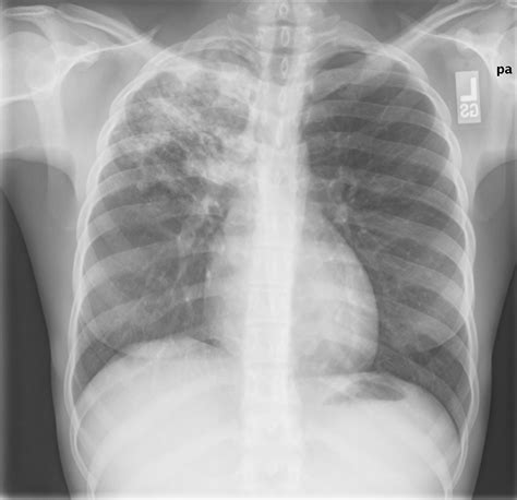 Pulmonary tuberculosis | Image | Radiopaedia.org