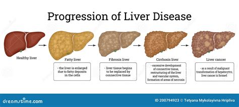 Illustration of the Stages of Liver Damage Stock Vector - Illustration of biology, cells: 200794923