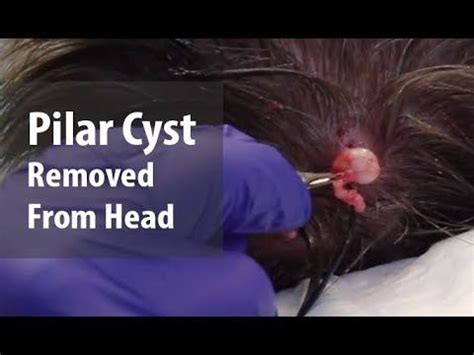 Pilar Cyst Removal | Dr. Derm | Derm, Cysts, Pilar