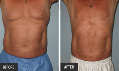 Botched and Revision Liposuction at the St Louis Lipo Center | St Louis Laser Lipo