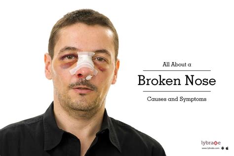 Broken Nose (Nasal Fracture) Age Groups And Types, Symptoms, Diagnosis, Treatment | atelier-yuwa ...