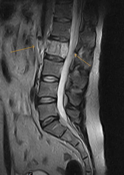 Aggressive Vertebral Hemangioma - Sumer's Radiology Blog