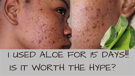 I USED ALOE VERA ON MY ACNE/ SCARS (SPOTS) FOR 15 DAYS & THIS HAPPENED (before & after ...