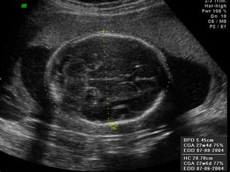 Fetal Head Measurements