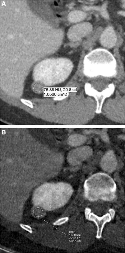 60-year-old man with pathologically proven papillary RCC. A Axial CT... | Download Scientific ...