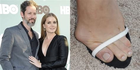 Celebrities With Bunions Surgery 28 Celebs With Ugly Feet: Gross Corns ...