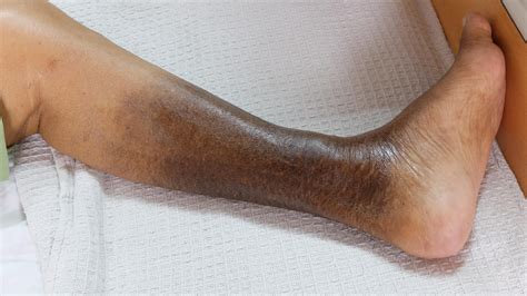 Leg discoloration. El Paso I&I Specialists Vascular experts. 915-260-6902