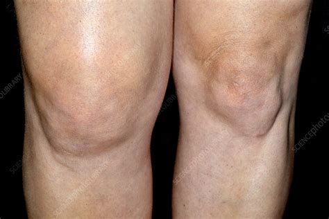 Swollen knee - Stock Image - C026/3365 - Science Photo Library