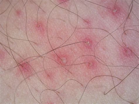 Folliculitis - Dr Jonathan Bowling