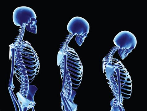 What are Osteoporosis Symptoms? | CleverTopic