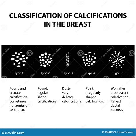 Classificação Das Calcificações Na Glândula Mamário Mammography a Glândula Mamário Infographics ...