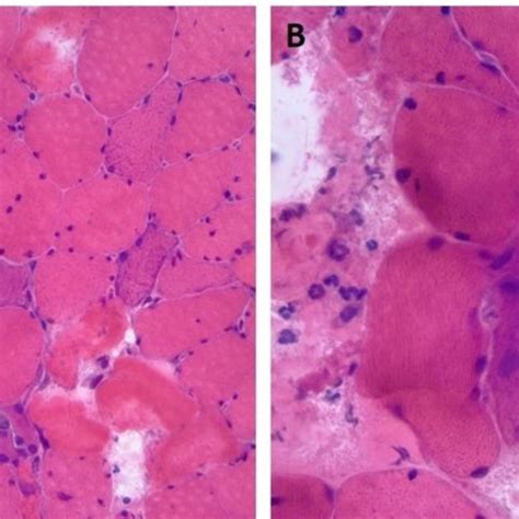 Myositis India