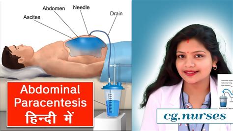 Abdominal Paracentesis || Procedure || Hindi || Nursing ...