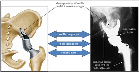 Review of hemipelvectomy endoprostheses: Indications and imaging ...