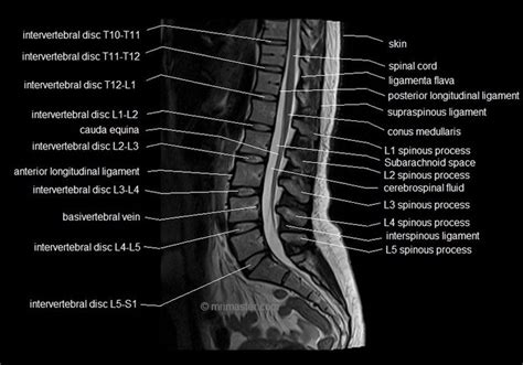 MRI lumbar spine sagittal cross sectional anatomy image 6 | Mri, Medical radiography, Anatomy images