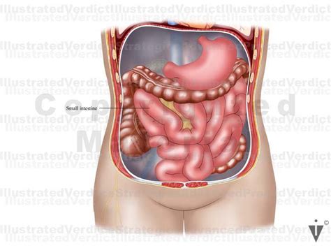 Stock Appendix: Appendicitis / Retrocecal — Illustrated Verdict