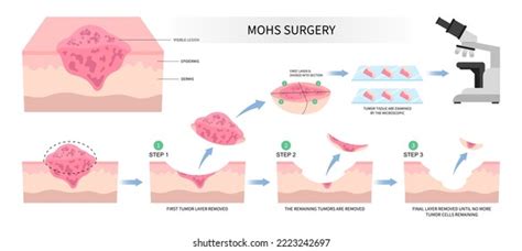 18 Scar Removal & Skin Grafting Images, Stock Photos & Vectors | Shutterstock