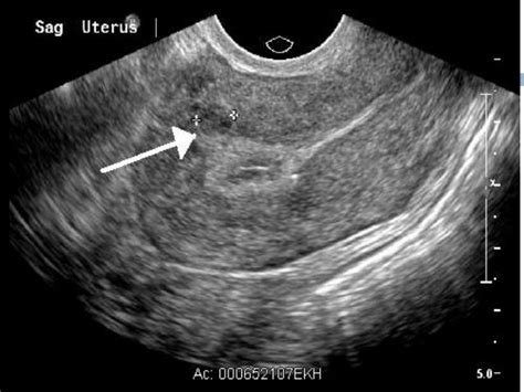 Uterine Fibroids on Ultrasound