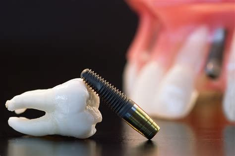 Bisphosphonate Continues to be Linked to Dental Implant Failure - Today ...