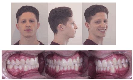 Functional treatment of maxillary hypoplasia and mandibular prognathism