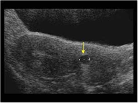 Gynaecology | 3.1 Uterus : Case 3.1.2 Miscellaneous benign uterine and cervical lesions ...