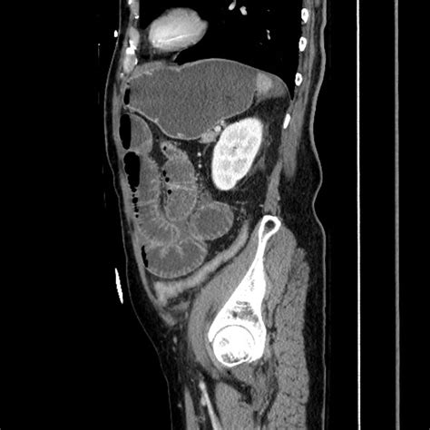 File:Closed loop obstruction due to adhesive band, resulting in small ...