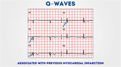 How to Read an ECG | ECG Interpretation | EKG | Geeky Medics