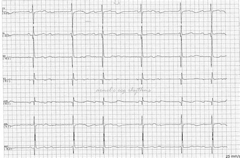 ECG Rhythms: Complete Heart Block or Not?