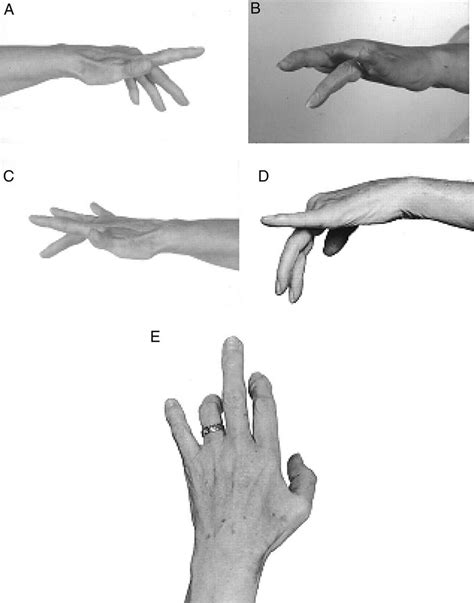 Multifocal motor neuropathy, causes, symptoms, diagnosis, treatment & prognosis