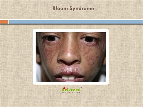 Bloom Syndrome by lazoithelife - Issuu