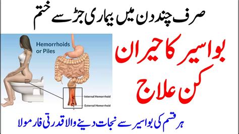 Bawaseer Ka Desi Ilaj | Cure Piles Naturally | Home Remedies For Piles | Bawasir - YouTube