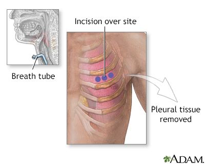 Open pleural biopsy Information | Mount Sinai - New York