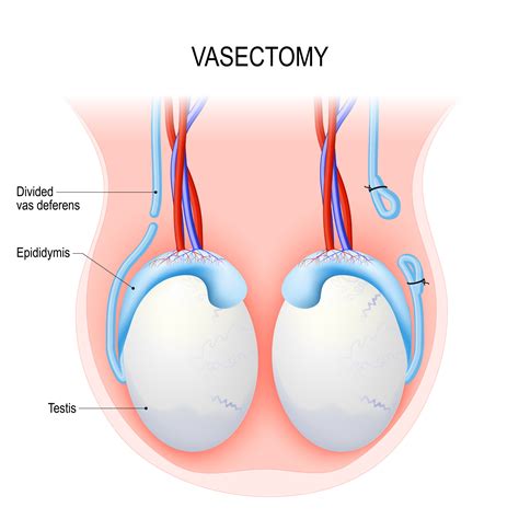 How Painful is a Vasectomy? | Vasectomy — Vasectomy.ie