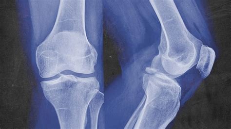 Avulsion fracture: Treatment, types, recovery time, and causes