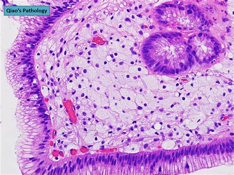 Qiao's Pathology: Gastric Xanthoma (Xanthelasma) | Microscop… | Flickr