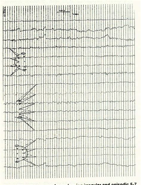 Figure 1 from Acquired childhood aphasia with convulsive disorder ...