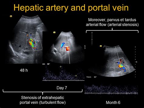 Hepatic Artery Ultrasound