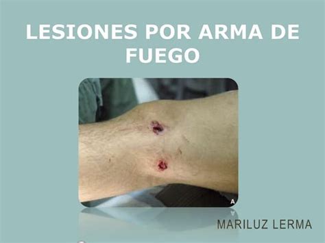 Heridas por arma de fuego